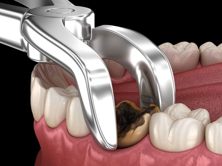 tooth-extraction
